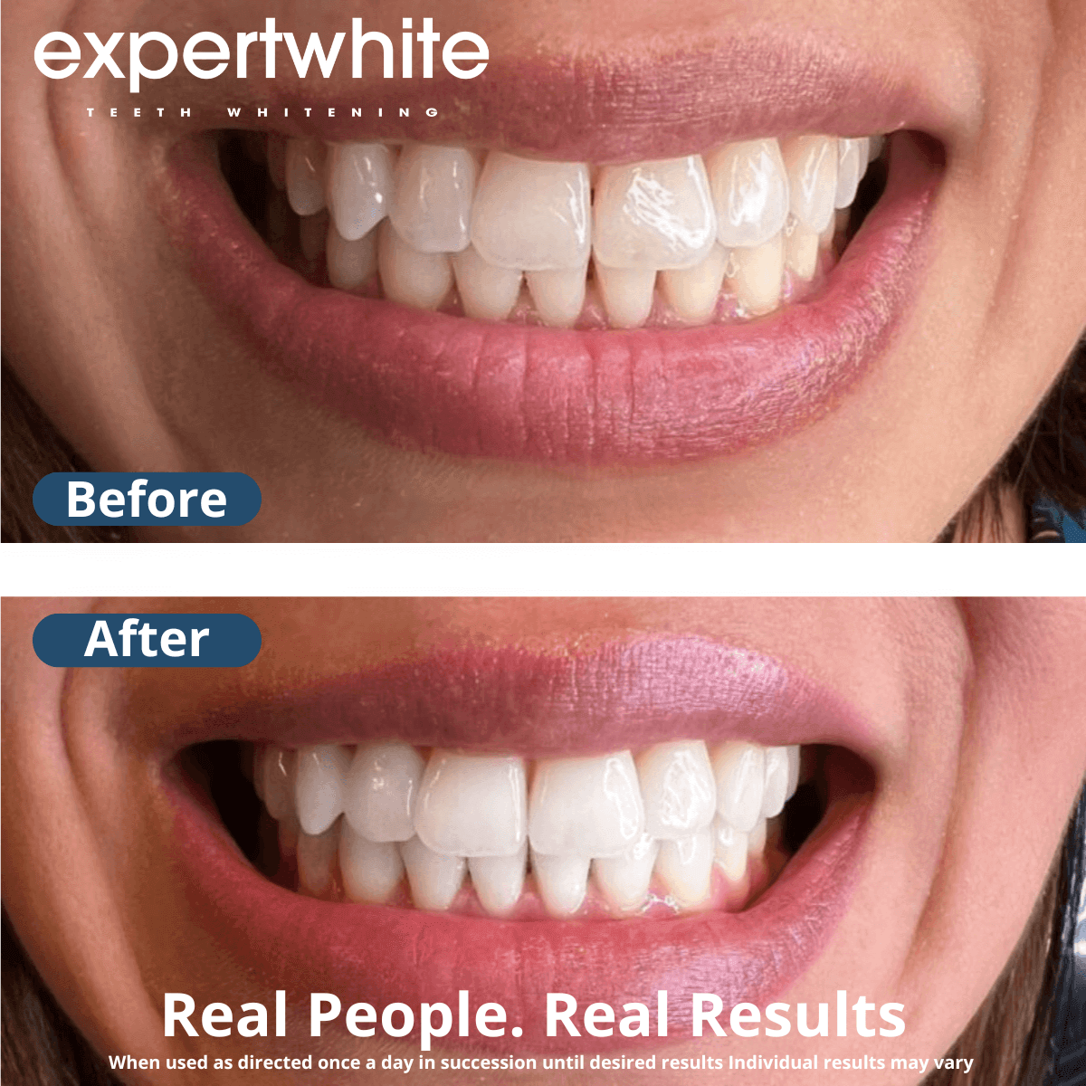 Expertwhite Teeth Whitening strips Max+ Instant Teeth Whitening Strips
Professional-Grade. Advanced Dry-Tech. No Slip. Stains Gone.