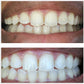 Expertwhite Teeth Whitening strips Teeth Whitening Strips: 12% Dentist-Grade USA Peroxide. Enamel Safe. 10 Shades Whiter in 5-7 Days.