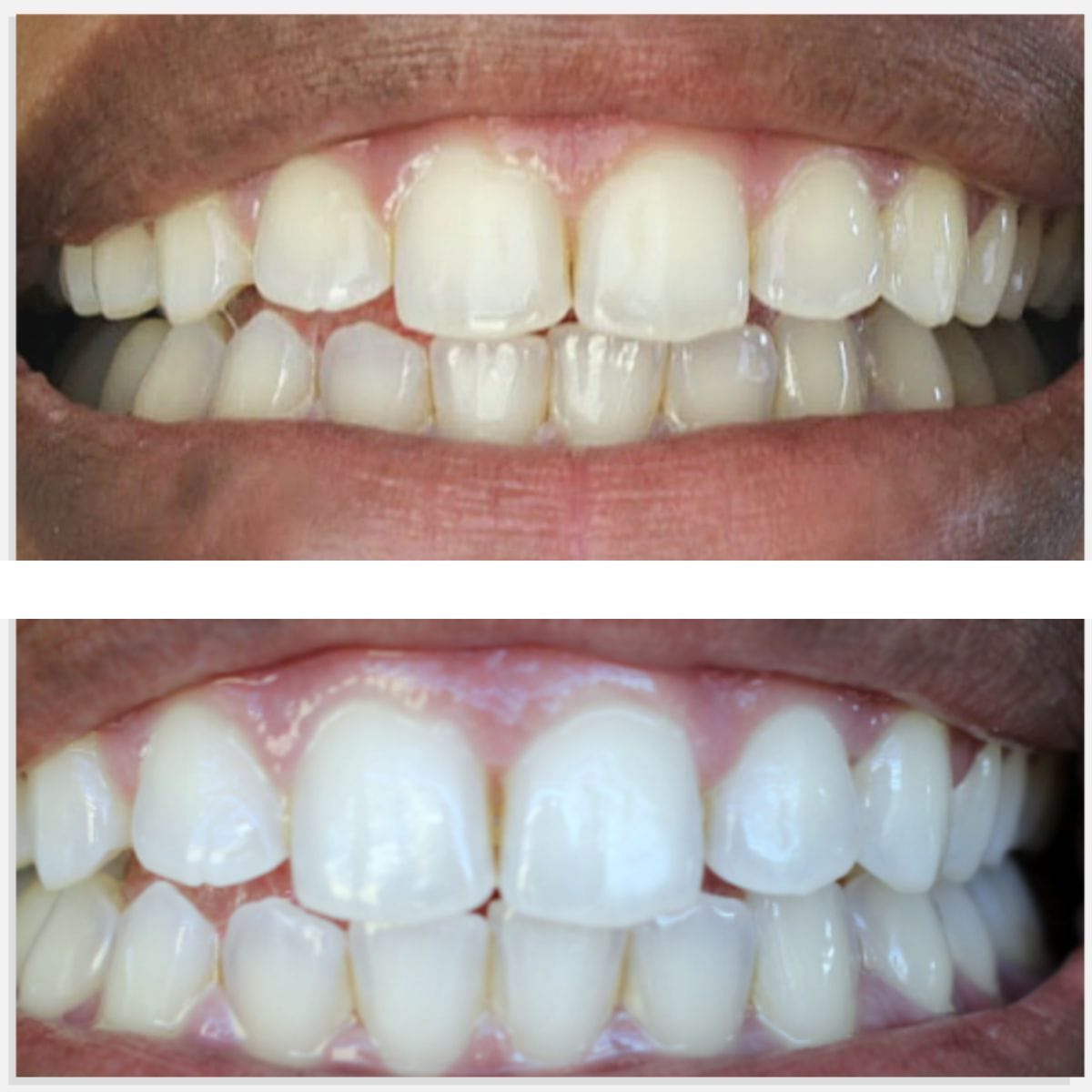 Expertwhite Teeth Whitening strips Teeth Whitening Strips: 12% Dentist-Grade USA Peroxide. Enamel Safe. 10 Shades Whiter in 5-7 Days.