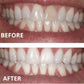 Expertwhite Teeth Whitening strips Teeth Whitening Strips: 12% Dentist-Grade USA Peroxide. Enamel Safe. 10 Shades Whiter in 5-7 Days.