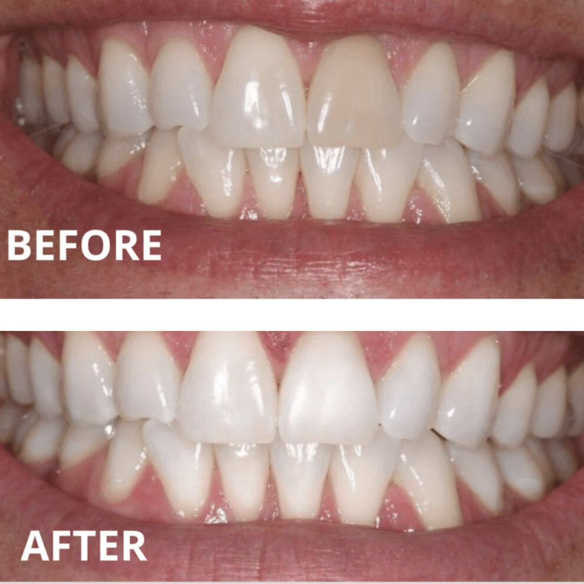 Expertwhite Teeth Whitening strips Teeth Whitening Strips: 12% Dentist-Grade USA Peroxide. Enamel Safe. 10 Shades Whiter in 5-7 Days.