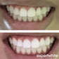 Expertwhite Teeth Whitening strips Teeth Whitening Strips: 12% Dentist-Grade USA Peroxide. Enamel Safe. 10 Shades Whiter in 5-7 Days.