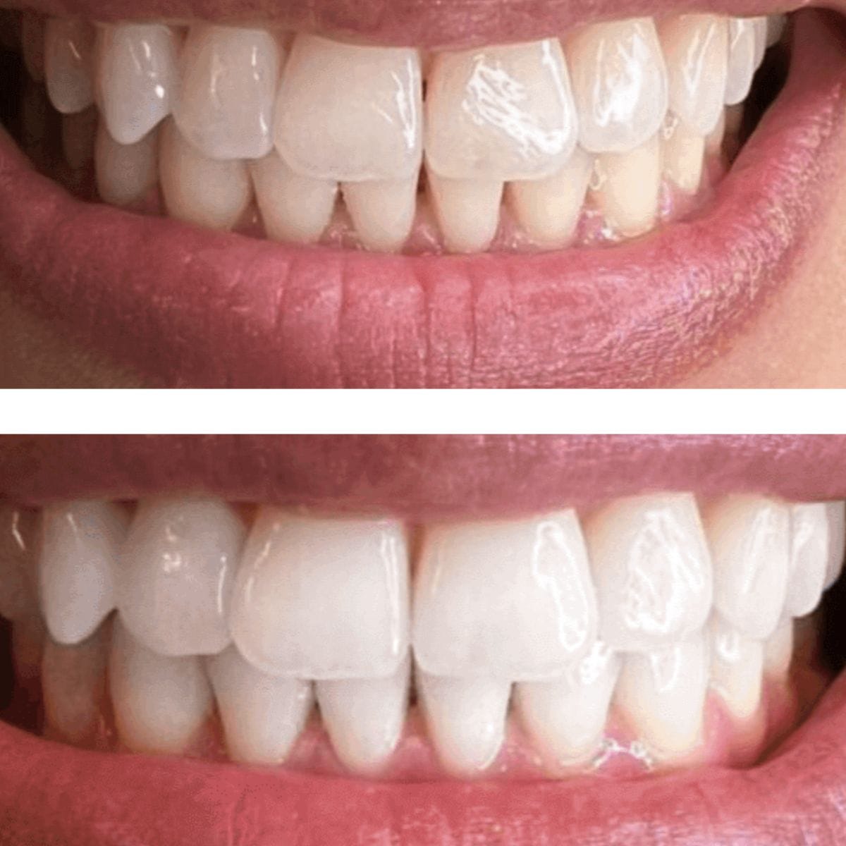 Expertwhite Teeth Whitening strips Teeth Whitening Strips 12%HP USA | Expertwhite