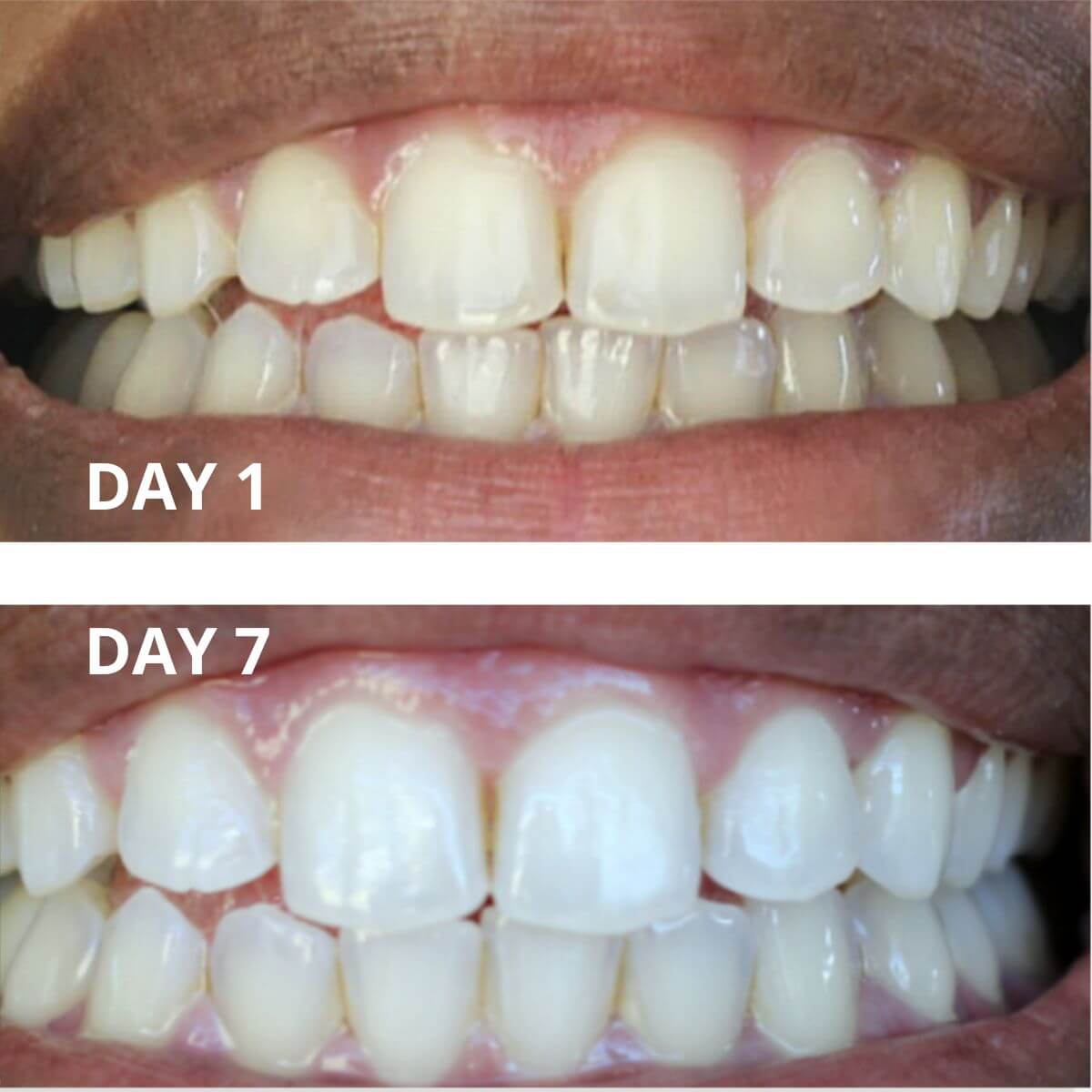Expertwhite Teeth Whitening strips THE WONDER STRIPS™ - with Matrix Technology - For a Blindingly White Smile.
