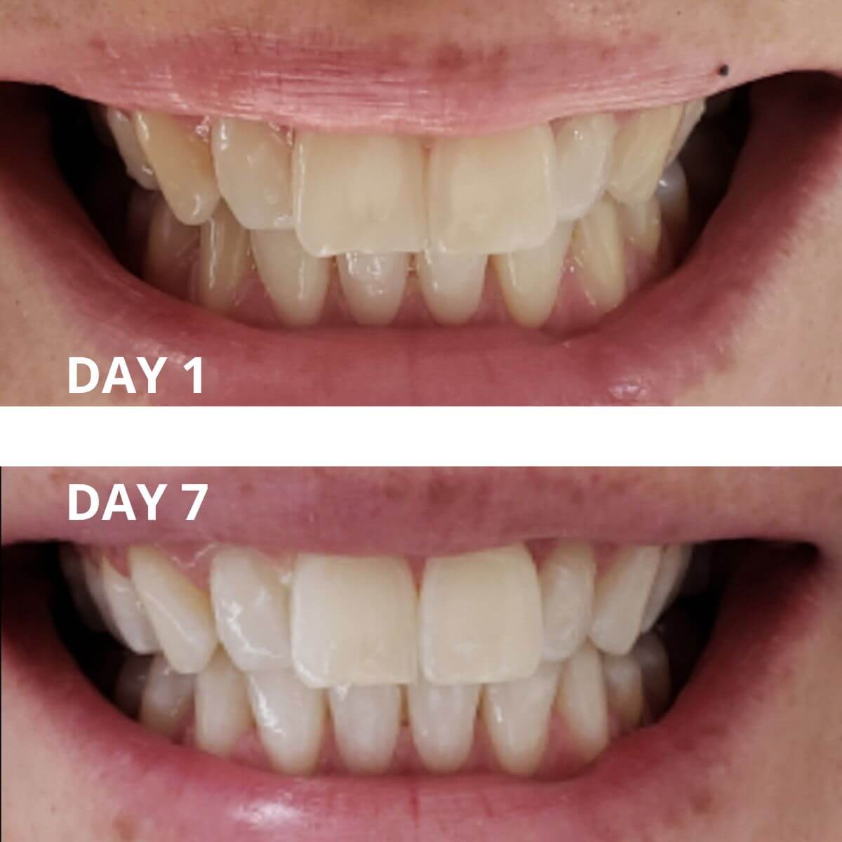 Expertwhite Teeth Whitening strips THE WONDER STRIPS™ - with Matrix Technology - For a Blindingly White Smile.