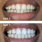 Expertwhite Teeth Whitening strips THE WONDER STRIPS™ - with Matrix Technology - For a Blindingly White Smile.