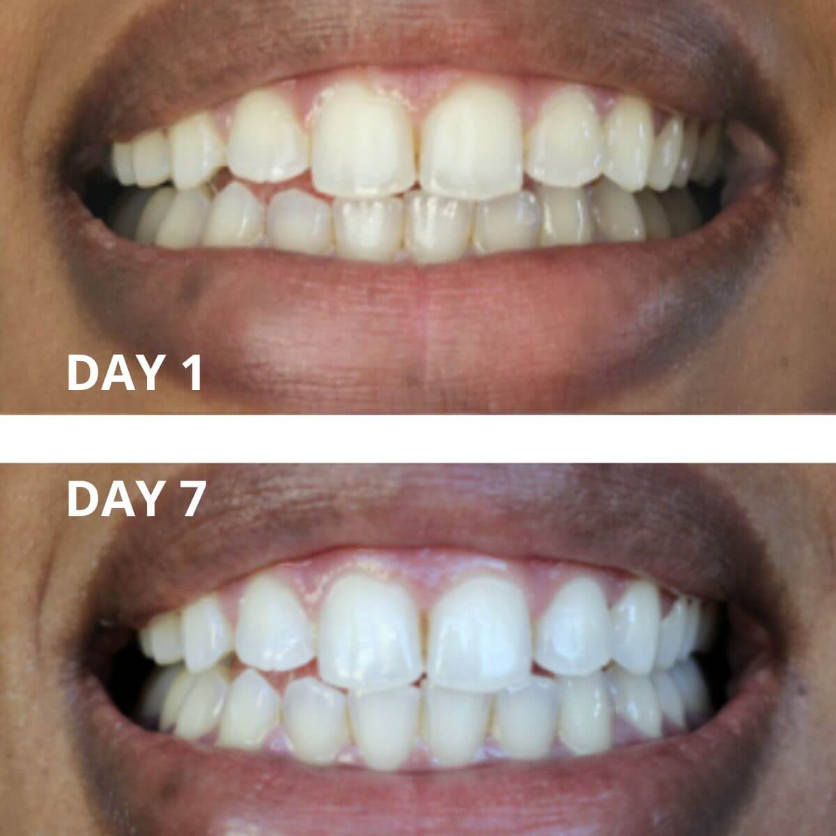 Expertwhite Teeth Whitening strips THE WONDER STRIPS™ - with Matrix Technology - For a Blindingly White Smile.