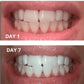 Expertwhite Teeth Whitening strips THE WONDER STRIPS™ - with Matrix Technology - For a Blindingly White Smile.