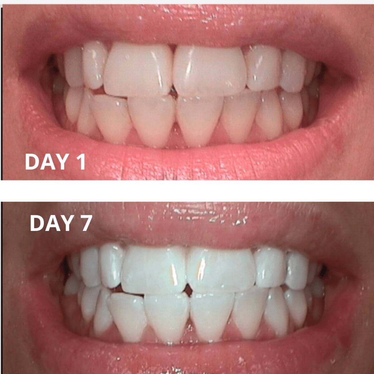 Expertwhite Teeth Whitening strips THE WONDER STRIPS™ - with Matrix Technology - For a Blindingly White Smile.