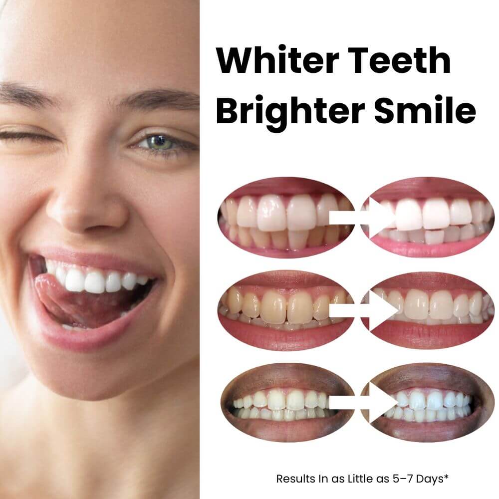 Expertwhite Teeth Whitening Trays Expertwhite FlexFit™ 12%HP Prefilled Teeth Whitening Trays