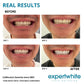 Expertwhite Teeth Whitening Trays Expertwhite Teeth Whitening Wraps: Dentist-Grade 12% Hydrogen Peroxide.  Visible Results in 3–5 Days