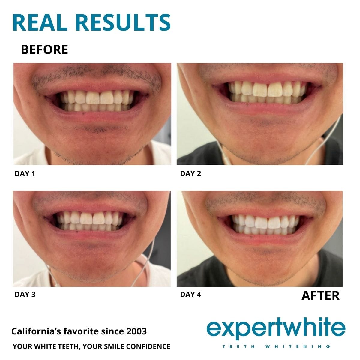 Expertwhite Teeth Whitening Trays Expertwhite Teeth Whitening Wraps: Dentist-Grade 12% Hydrogen Peroxide.  Visible Results in 3–5 Days