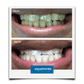 Expertwhite Teeth Whitening Trays Kit Expertwhite Max+ Prefilled Whitening Trays