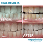 Expertwhite Teeth Whitening Trays Kit Expertwhite Max+ Prefilled Whitening Trays