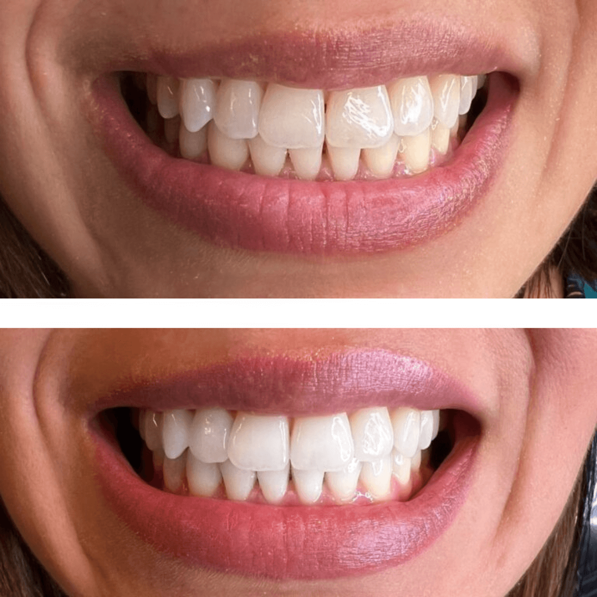 Expertwhite Teeth Whitening Trays Kit Expertwhite Preloaded+ Whitening Trays