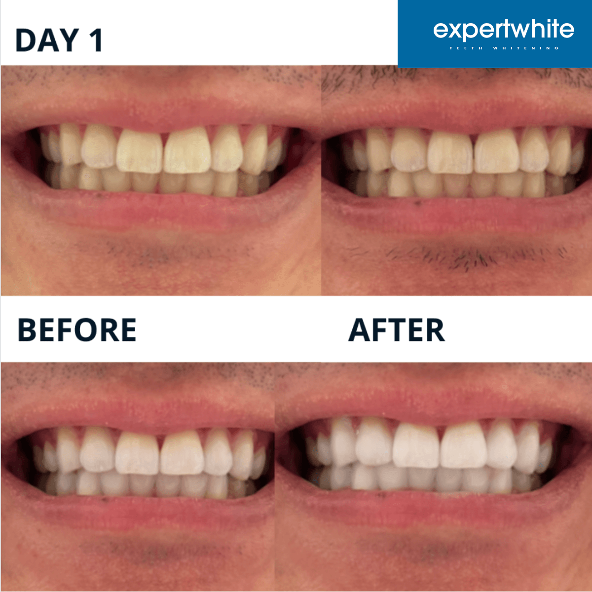 Expertwhite Teeth Whitening Trays Kit Instant Glow Trays