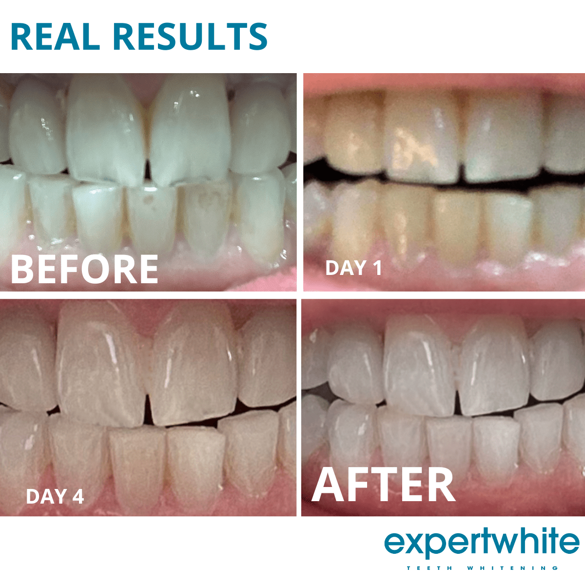 Expertwhite Teeth Whitening Trays Kit Instant Glow Trays
