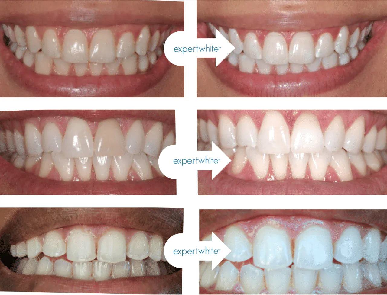 Expertwhite Teeth Whitening Trays Kit Teeth Whitening Trays – 35% Carbamide Peroxide, Preloaded Foam-Lined Gel for Close Contact Whitening
