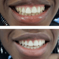 Expertwhite Teeth Whitening Trays Kit Ultra+ Prefilled Whitening Trays
