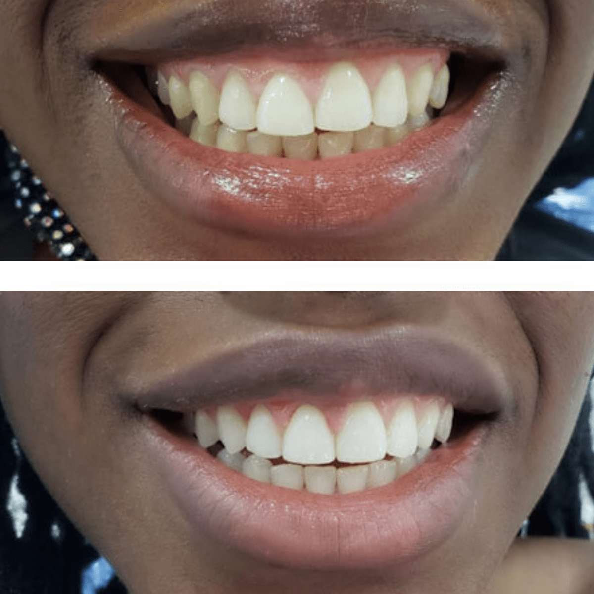 Expertwhite Teeth Whitening Trays Kit Ultra+ Prefilled Whitening Trays