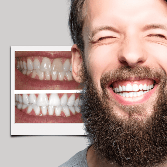 Best Dentist Teeth Whitening Gel For Invisalign Aligner style Retainer