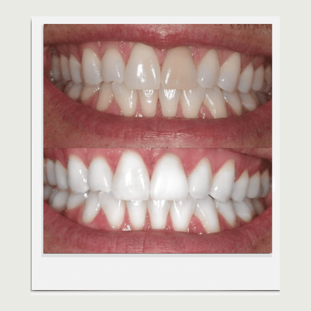 Expertwhitening Teeth Whitening Gels 8-gels (Save 25%) Expertwhite 44%CP Extreme Teeth Whitening Gel for Trays (15-minutes)