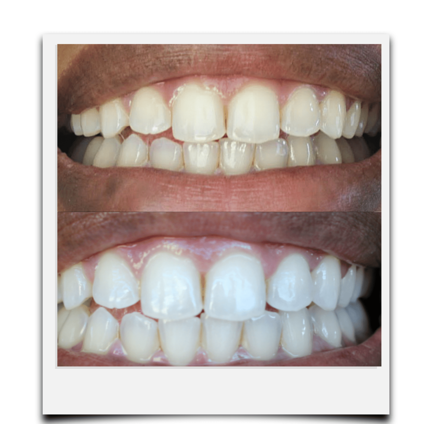 Expertwhitening Teeth Whitening Kit Expertwhite USA Brilliance Boost Teeth Whitening Bundle